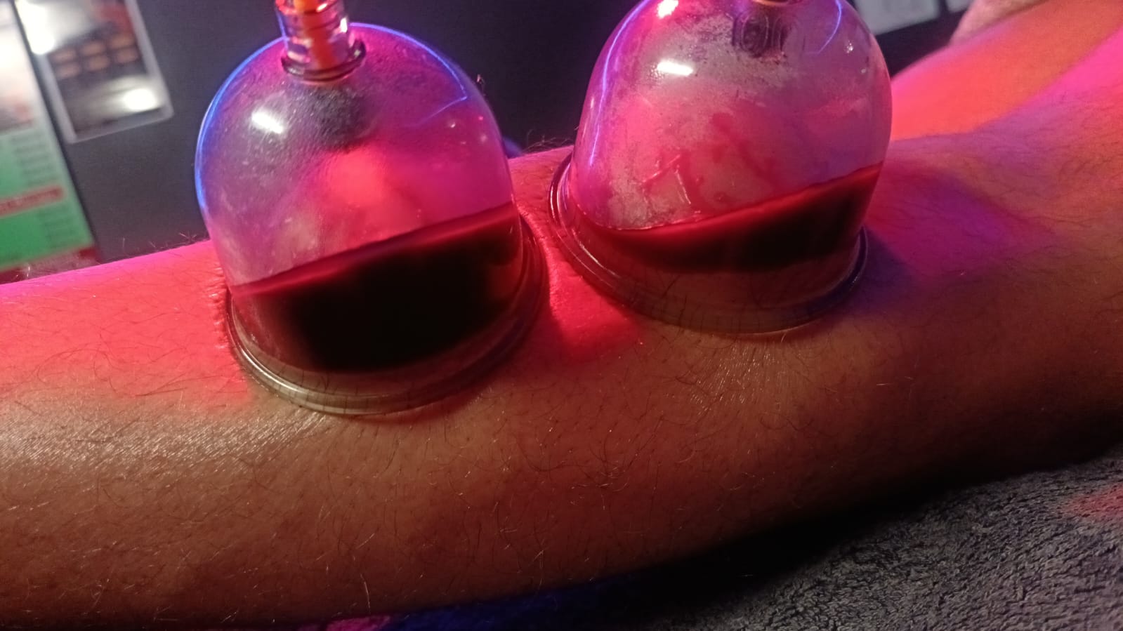 Wet cupping treatment in progress