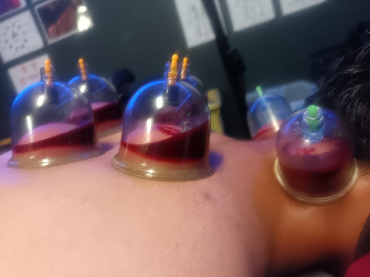 Wet cupping treatment