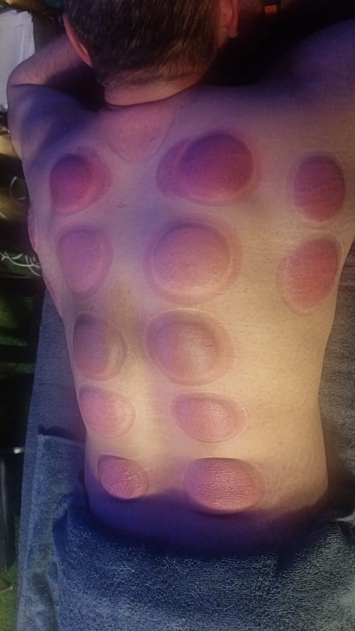 Wet cupping marks result on back