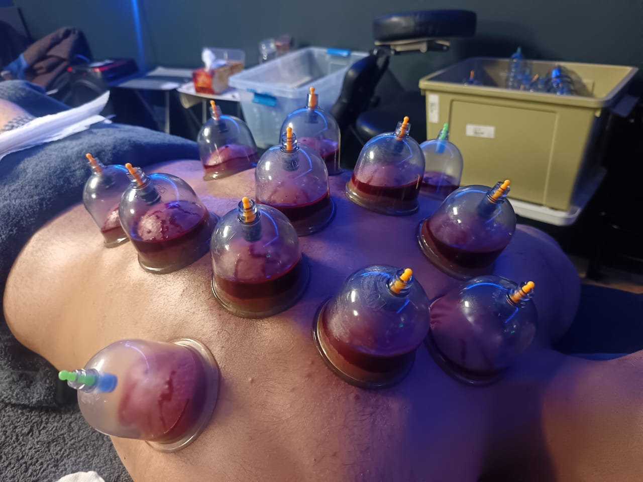 Wet cupping treatment