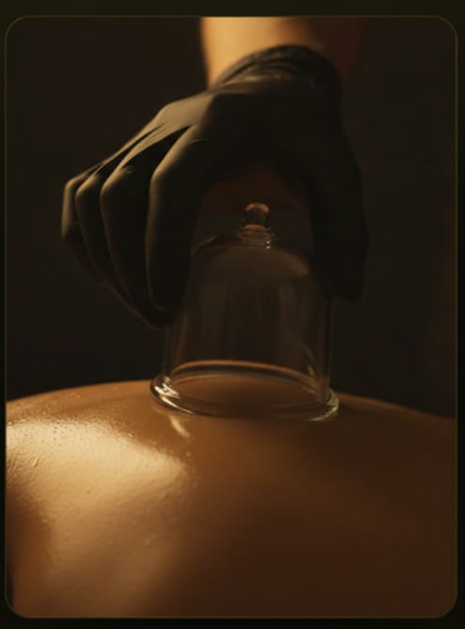 Wet cupping (hijama) therapy in progress on a client's back
